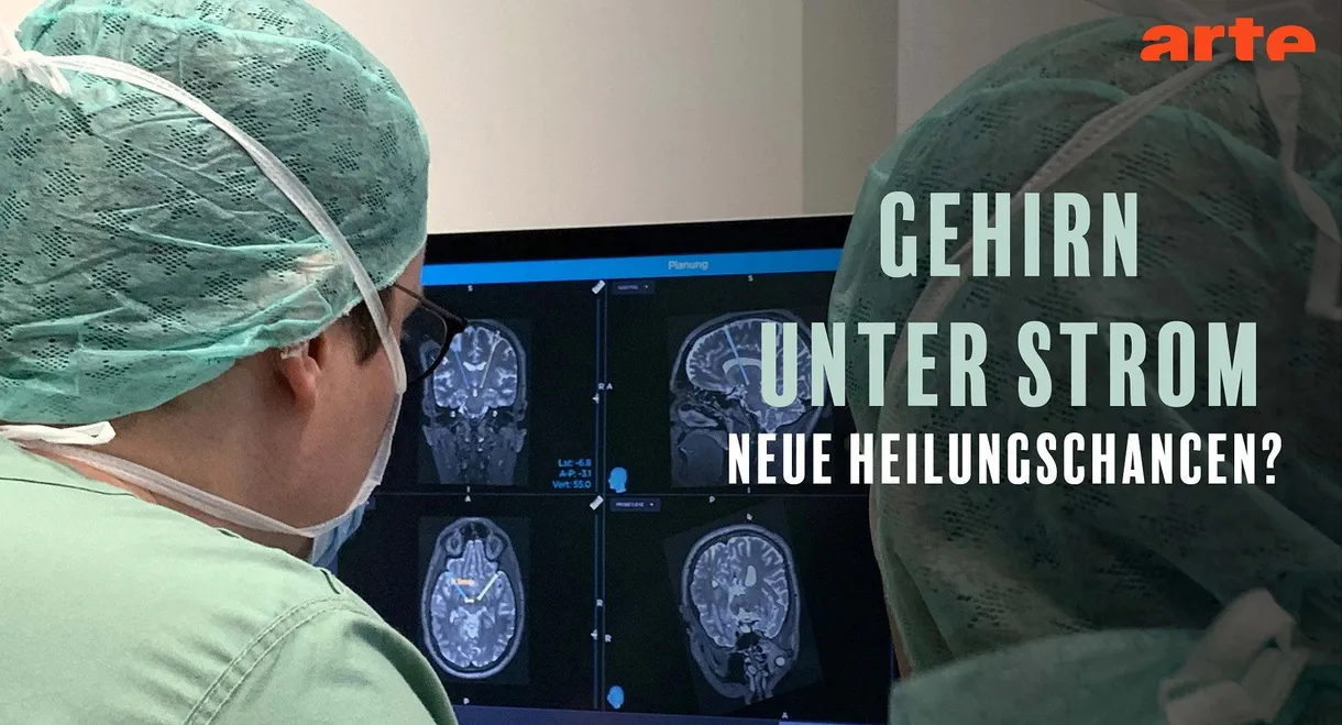 Gehirn unter Strom - Hilfe bei Depression, Epilepsie und Parkinson?