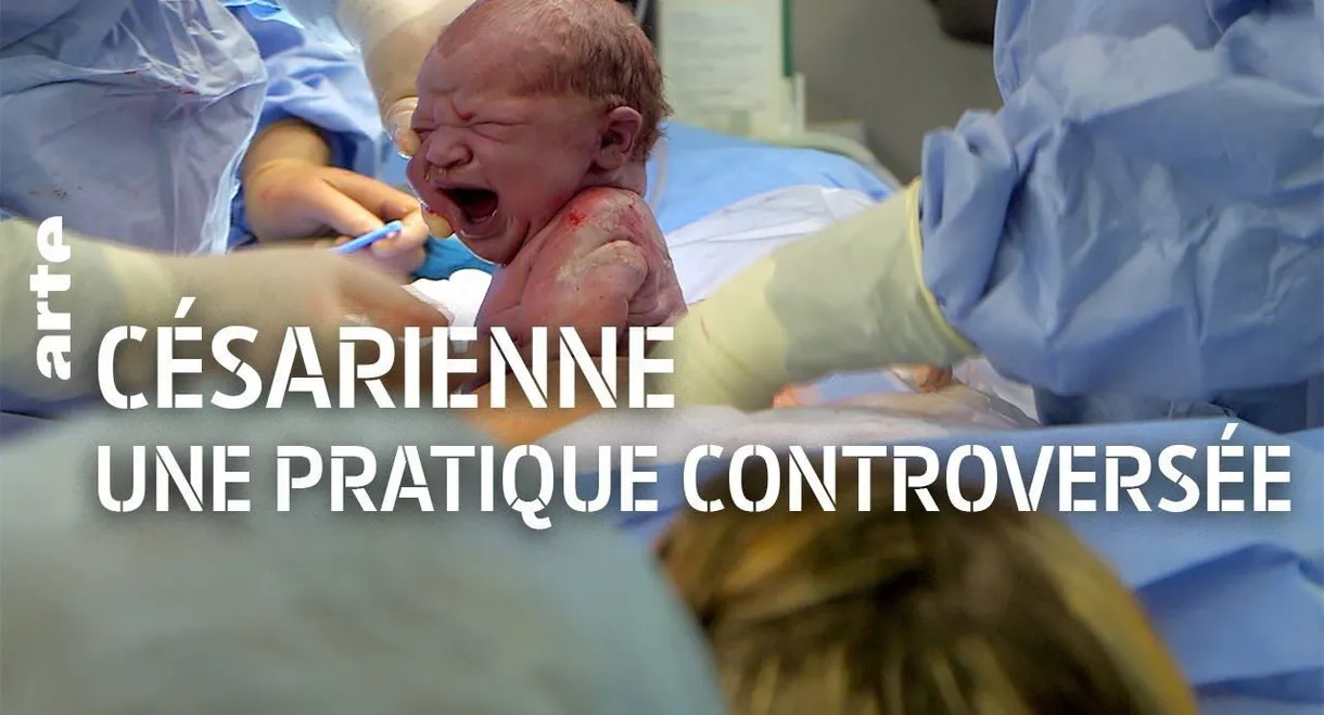 The C-Section Controversy